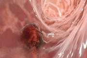 Colorectal polyp prevalence and adenoma detection rates in an Iranian cohort: a prospective study