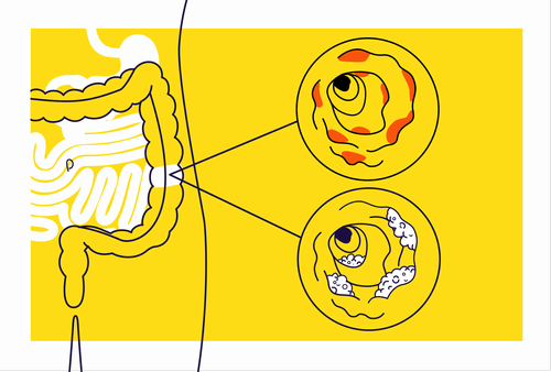 Sex and age differences in inflammatory bowel disease patients a nationwide study based on Iranian Registry of Crohn’s and Colitis (IRCC)