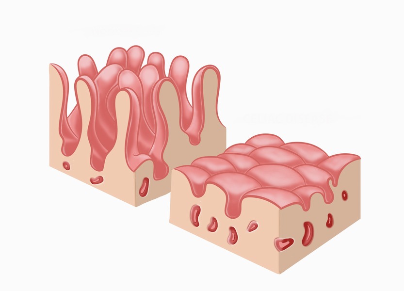 Celiac disease