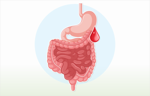 In-hospital mortality in patients with lower gastrointestinal bleeding: development and validation of a prediction score